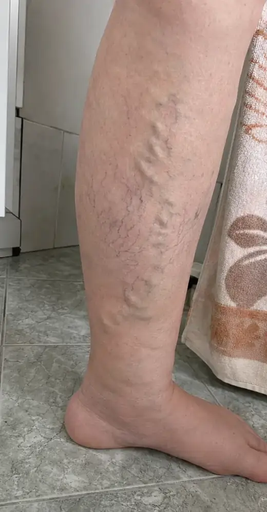 Vene vizibile pe gambă
